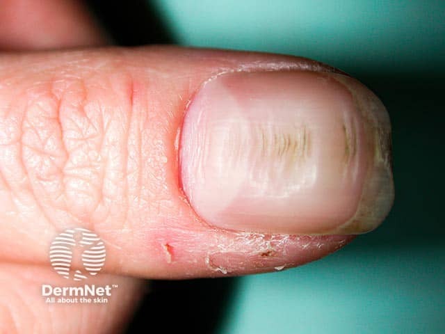 Поперечные борозды ногтевой пластинки с частичной утратой эпонихия (кутикулы) и валикообразным нависанием проксимального ногтевого валика в результате его повторяющегося смещения соседним указательным пальцем.