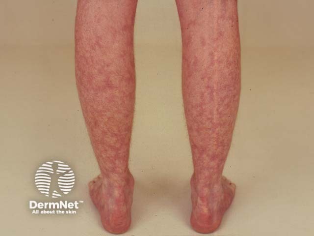 Сетчатое ливедо (livedo reticularis)