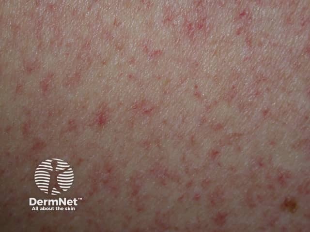 Доброкачественная наследственная телеангиэктазия