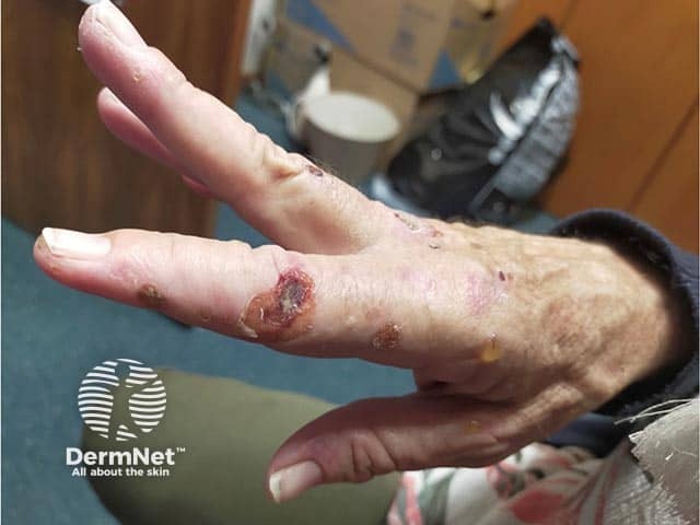 Пузыри и эрозии на тыльной поверхности кисти и пальцев при наследственной копропорфирии