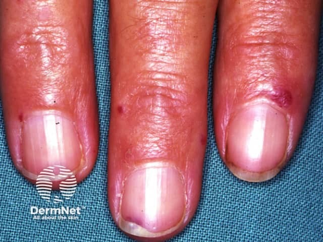 Наследственная геморрагическая телеангиэктазия