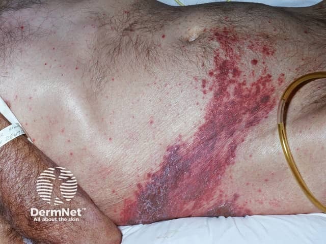Опоясывающий лишай (Herpes zoster)