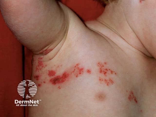 Опоясывающий лишай (Herpes zoster)