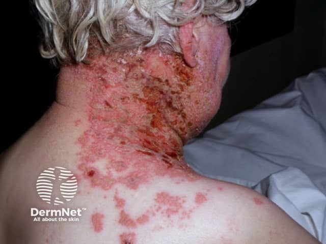 Опоясывающий лишай (Herpes zoster)