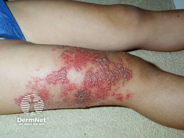 Опоясывающий лишай (Herpes zoster)