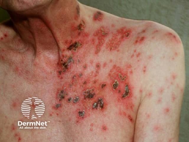Опоясывающий лишай (Herpes zoster)