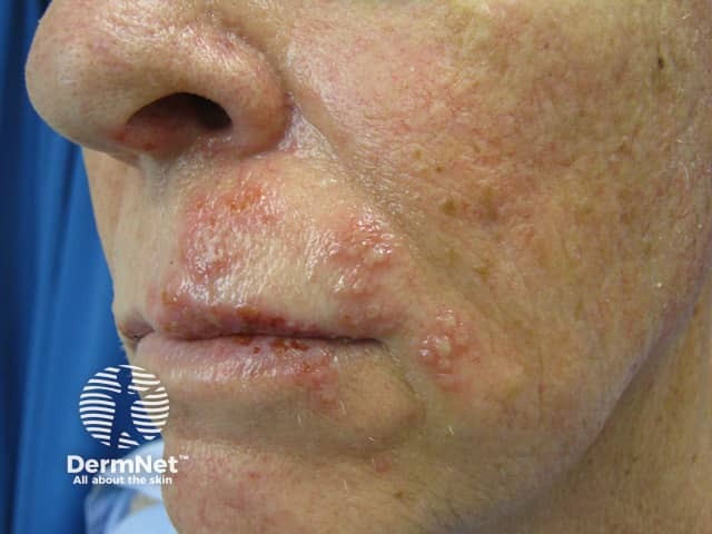 Опоясывающий лишай (Herpes zoster)