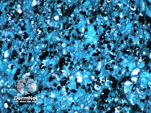 Рисунок 3. Окраска по Гомори-Грокотту (GMS), демонстрирующая многочисленные почкующиеся споры Histoplasma capsulatum размером 2–4 мкм.