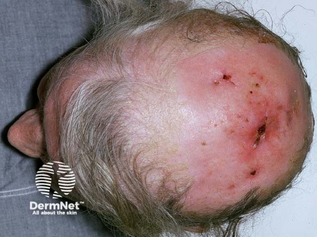 Экскориации (следы расчёсов) вследствие мучительного паранеопластического зуда
