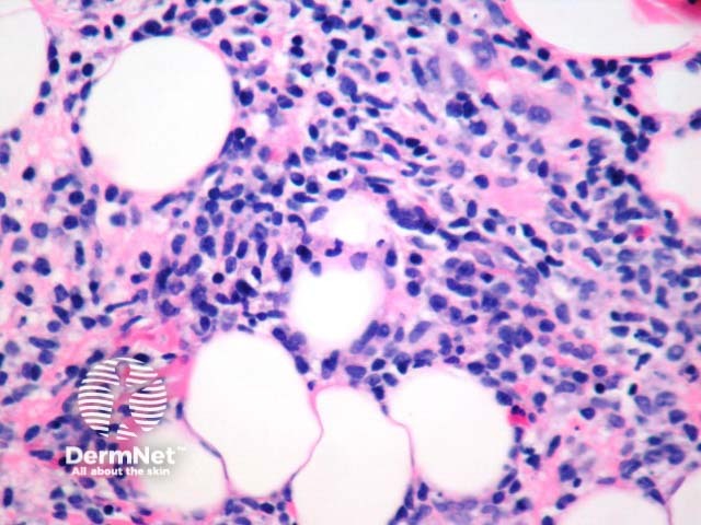 Рисунок 4. Hydroa vacciniforme-подобная Т-клеточная лимфома: массивный инфильтрат с вовлечением глубоких отделов дермы и подкожной клетчатки.
