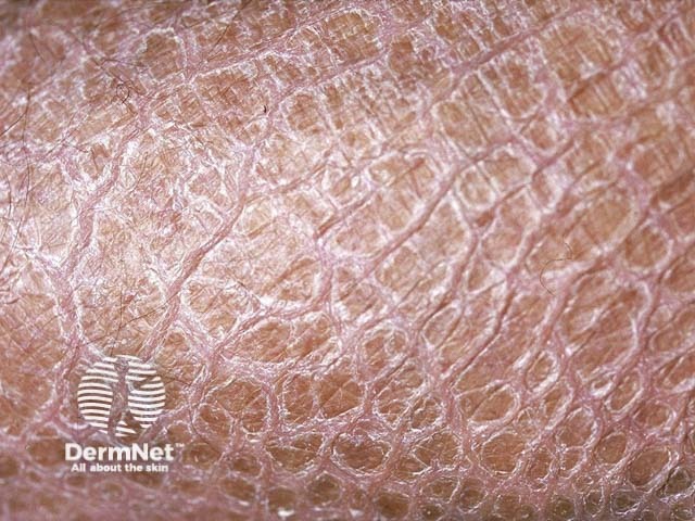 Ихтиоз: полигональные чешуйки на коже