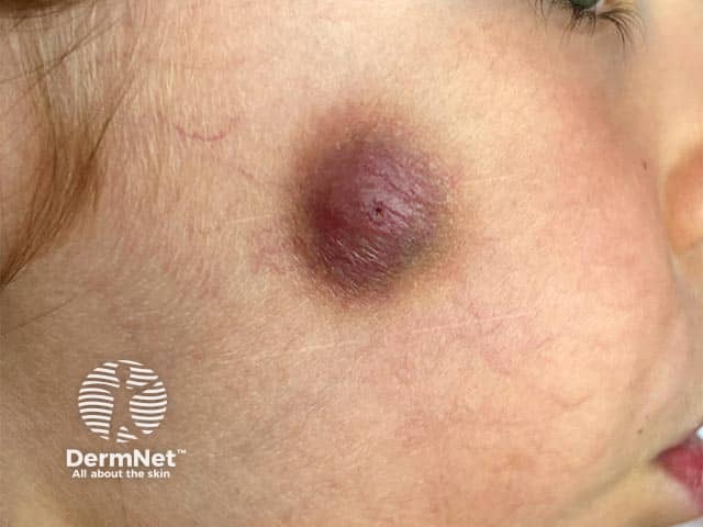 Синюшно-багровая бляшка на щеке при идиопатической асептической гранулеме лица