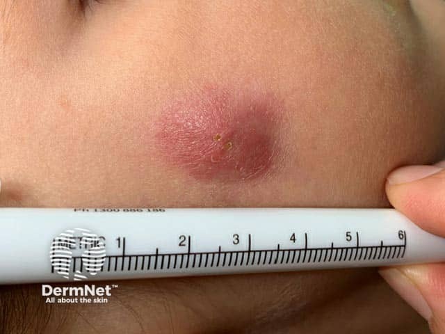 Плотная бляшка в области щеки у ребенка с идиопатической асептической гранулемой лица