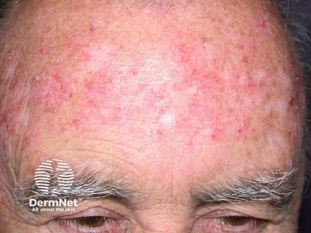 Местная воспалительная реакция на имиквимод при лечении актинического кератоза