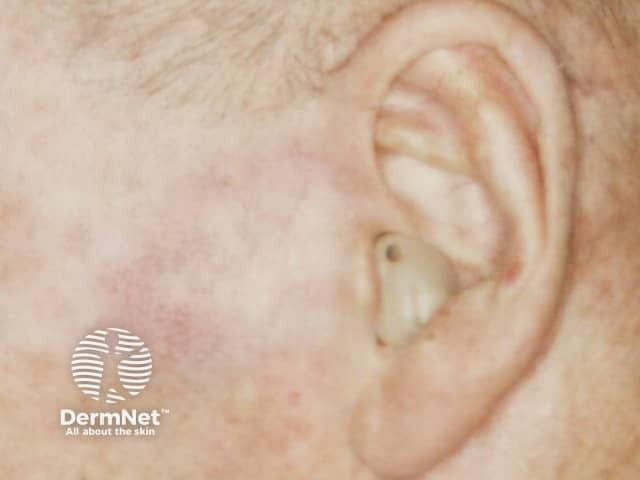 Эритематозно-эрозивная реакция в процессе терапии базальноклеточного рака кожи имиквимодом