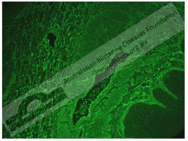 Листовидная пузырчатка (Pemphigus foliaceus)