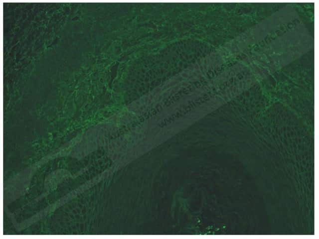 Вульгарная пузырчатка (Pemphigus vulgaris)