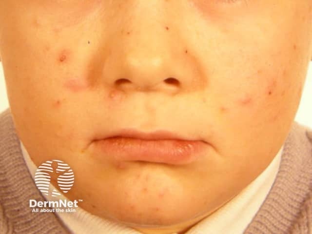 Младенческое акне (acne infantum)