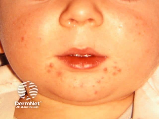 Младенческое акне (acne infantum): воспалительные папулы и пустулы на коже щеки