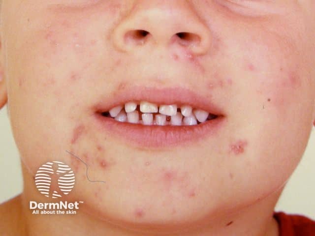 Младенческое акне (acne infantum)