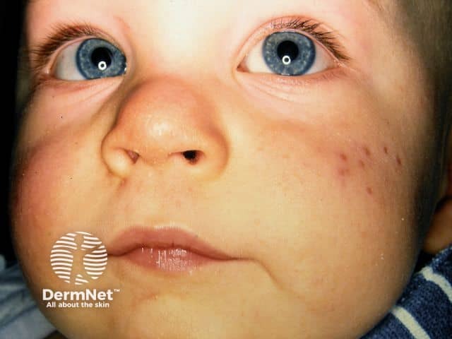 Младенческое акне (acne infantum): папуло-пустулезные элементы и комедоны