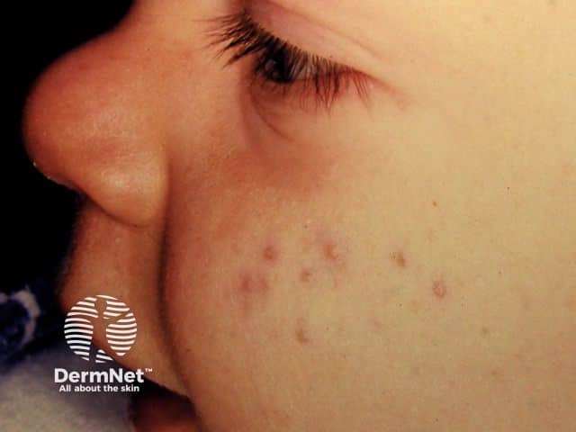 Младенческие угри: комедоны и воспалительные элементы
