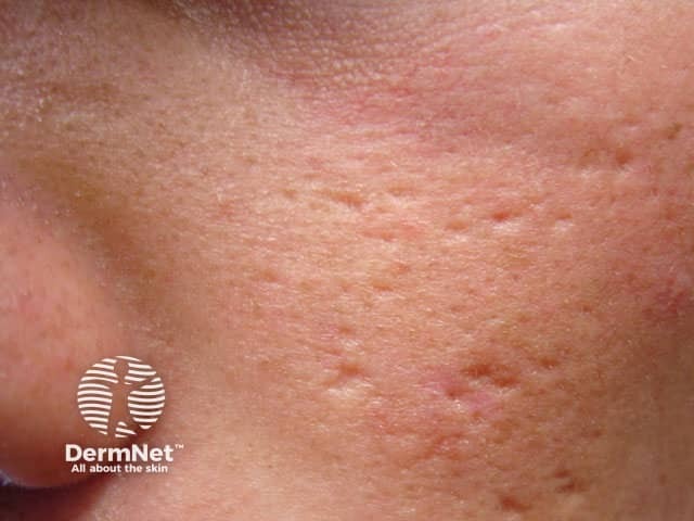 Рубцовые изменения постакне после младенческих угрей