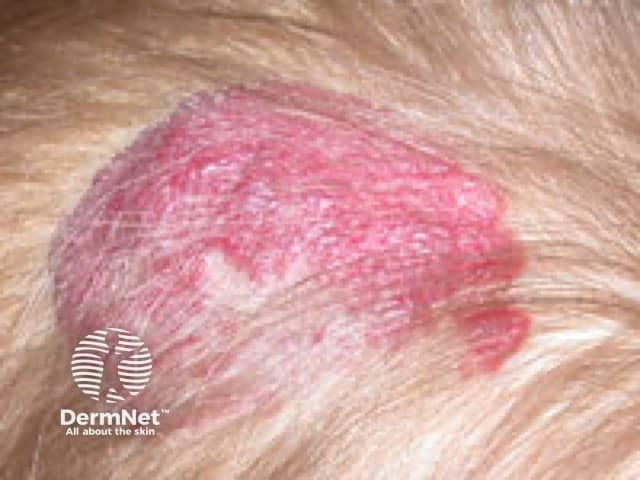 Регрессирующая младенческая гемангиома волосистой части головы
