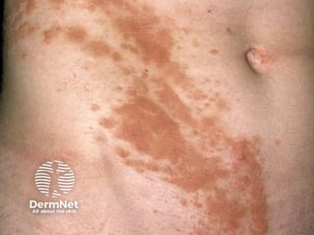 Распространенный ВЛВЭН (ILVEN) с характерным распределением вдоль линий Блашко