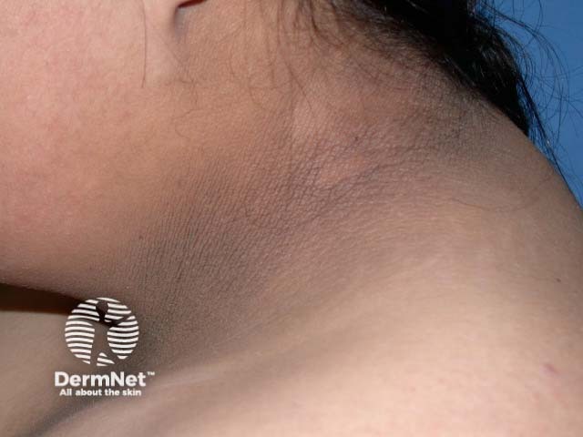 Черный акантоз (Acanthosis nigricans)