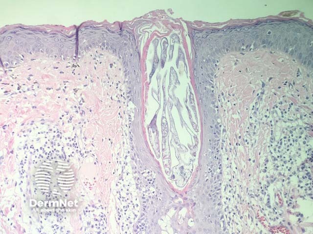 Рисунок 4. Клещи Demodex в просвете волосяного фолликула при периорбитальной форме заболевания.