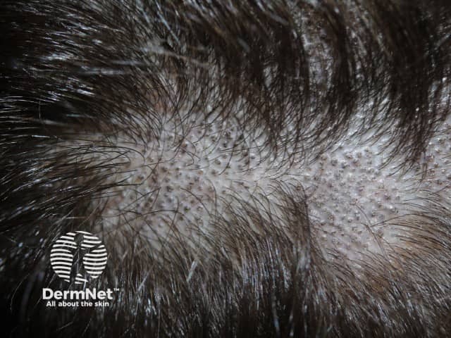 Микоз волосистой части головы (Tinea capitis)
