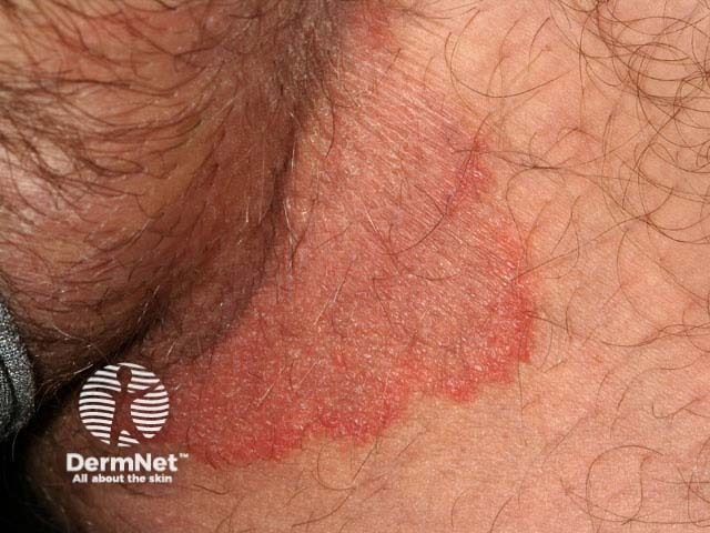 Паховая дерматофития (Tinea cruris)