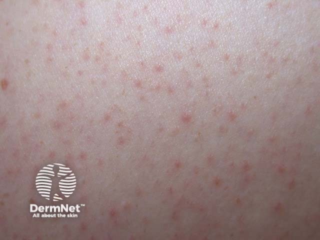 Фолликулярный кератоз: выраженный фолликулярный гиперкератоз