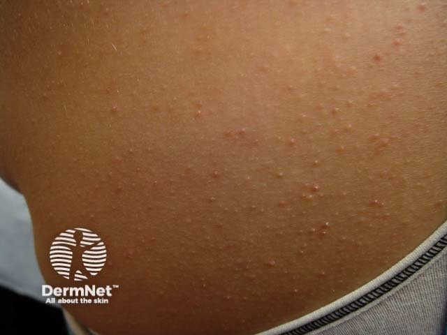 Фолликулярный кератоз: перифолликулярная эритема и роговые пробки в устьях волосяных фолликулов