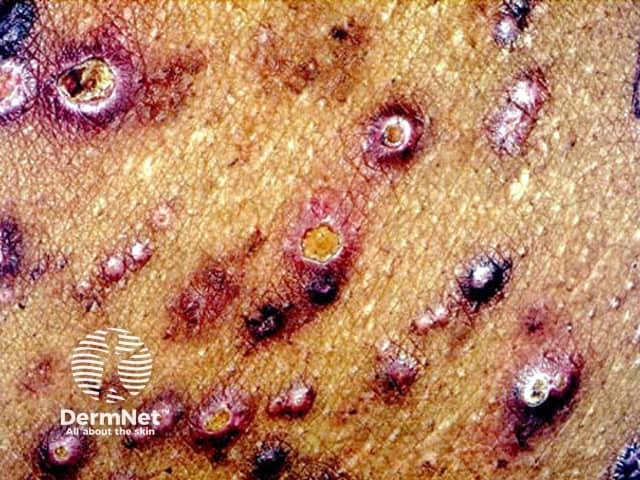 Болезнь Кирле: множественные узловатые элементы на нижних конечностях