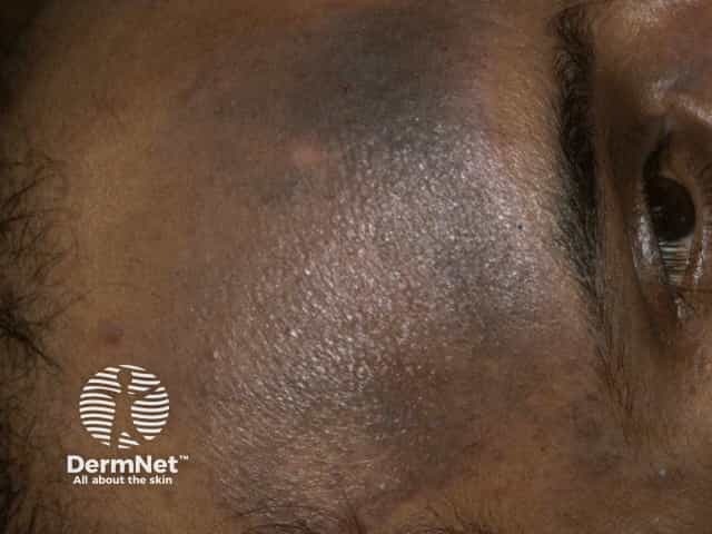 Гиперпигментация на фоне атопической экземы