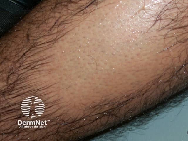 Лазерная эпиляция