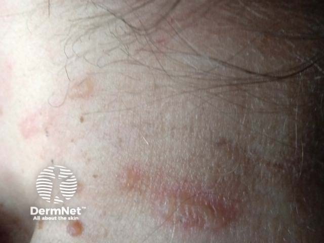 Буллезные элементы, вызванные контактом с ложным нарывником