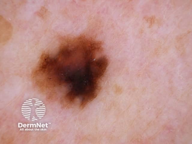 Простое лентиго