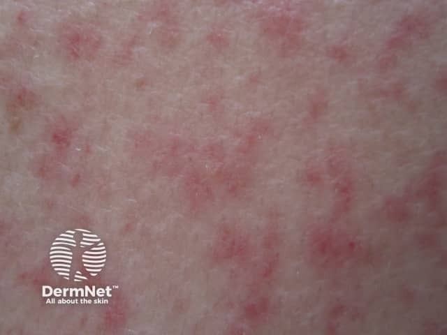 Лейкемия кожи: клинические проявления специфического поражения