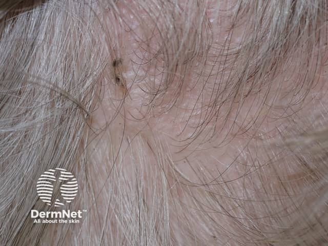 Головные вши (Pediculus humanus capitis)