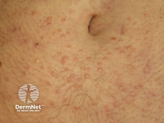 Склеромикседема: характерное поражение кожи кистей со склеродактилией