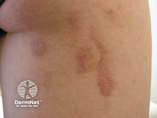 Берлоковая гиперпигментация после контакта с соком лайма
