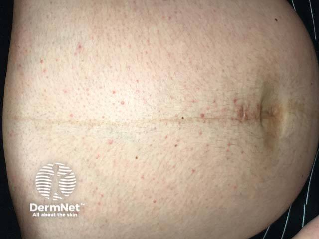 Черная линия живота (linea nigra)