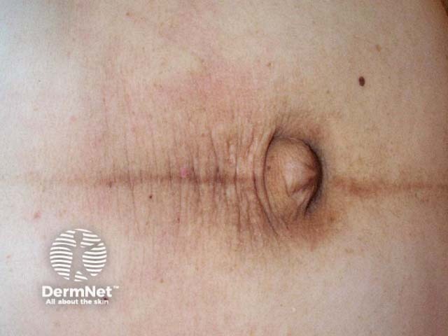 Черная линия живота (linea nigra)