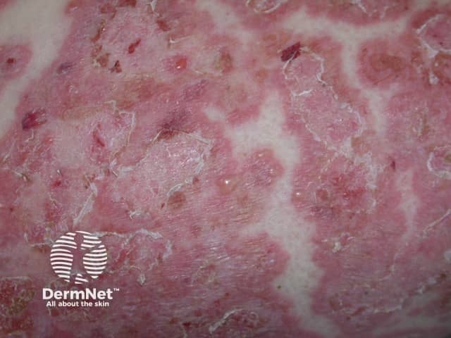 Буллезные высыпания при линейном IgA-дерматозе