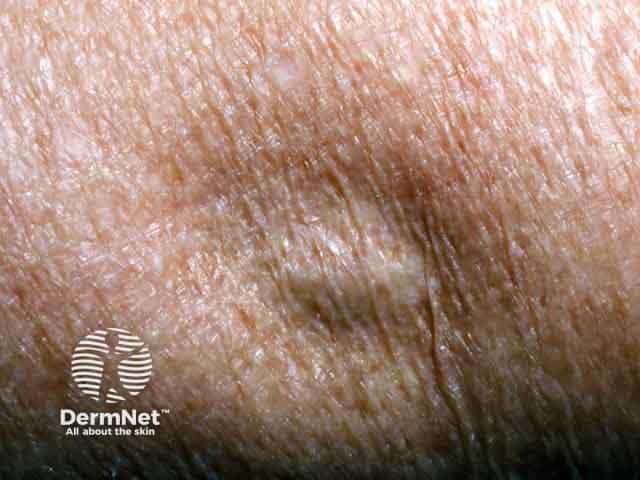 Липоатрофия руки, индуцированная инъекцией кортикостероидов