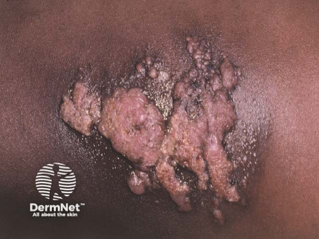 Ограниченная лимфангиома (Lymphangioma circumscriptum)
