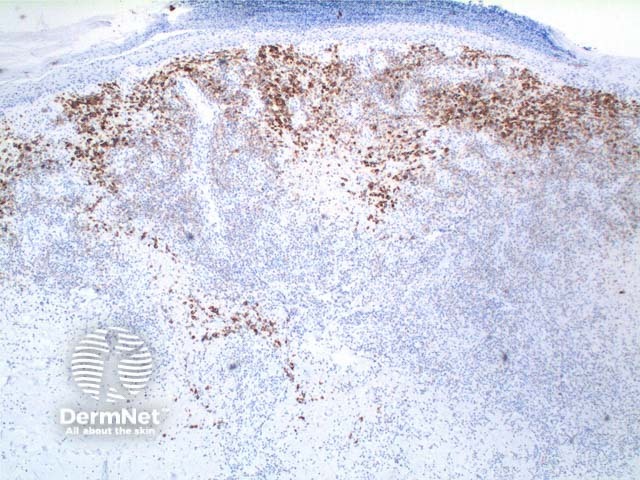 Рисунок 6. Крупные CD30-положительные атипичные лимфоциты (тип A) на фоне реактивного воспалительного пула клеток.